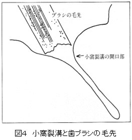 生涯むし歯なしで過ごすには6歳が最重要