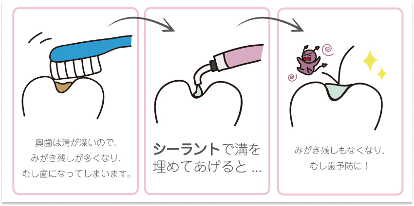 生涯むし歯なしで過ごすには6歳が最重要